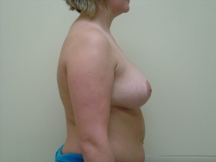 Breast Reduction Before & After Patient #1730