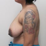 Breast Reduction Before & After Patient #1729