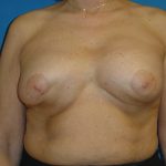 Breast Revision Before & After Patient #1744