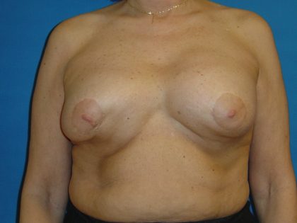 Breast Revision Before & After Patient #1744