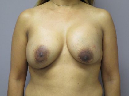 Breast Revision Before & After Patient #1742