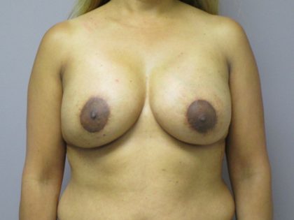 Breast Revision Before & After Patient #1742