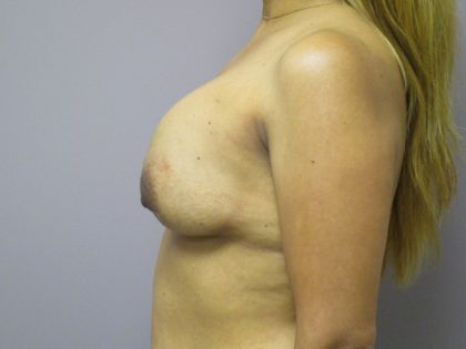 Breast Revision Before & After Patient #1742