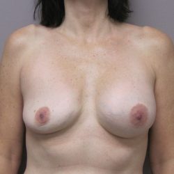 Breast Revision Before & After Patient #1741