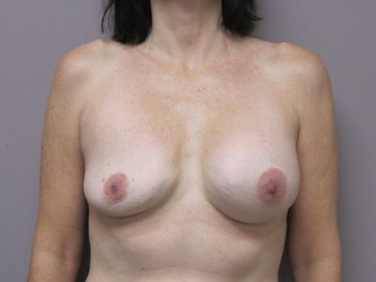 Breast Revision Before & After Patient #1741