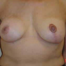 Breast Revision Before & After Patient #1739