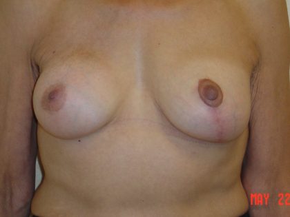 Breast Revision Before & After Patient #1739