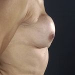 Breast Revision Before & After Patient #1739