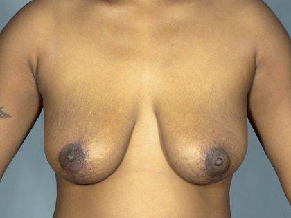 Breast Revision Before & After Patient #1738