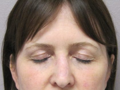 Browlift Before & After Patient #1653