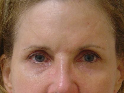 Browlift Before & After Patient #1656