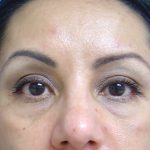 Eyelid Surgery Before & After Patient #1664