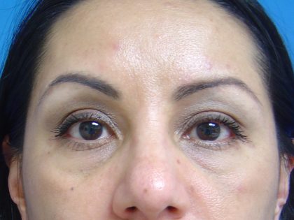 Eyelid Surgery Before & After Patient #1664