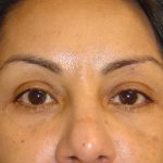 Eyelid Surgery Before & After Patient #1664