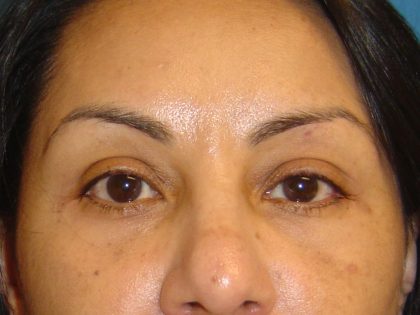 Eyelid Surgery Before & After Patient #1664