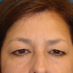 Eyelid Surgery Before & After Patient #1673