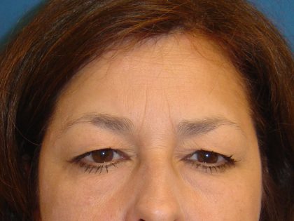 Eyelid Surgery Before & After Patient #1673