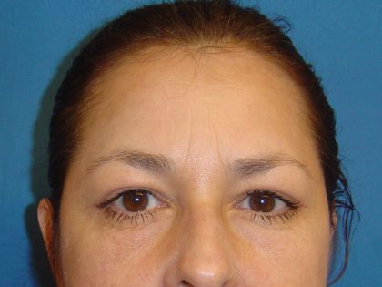 Eyelid Surgery Before & After Patient #1673