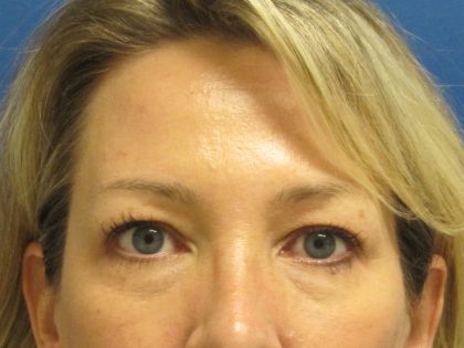 Eyelid Surgery Before & After Patient #1672