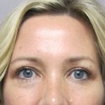 Eyelid Surgery Before & After Patient #1672