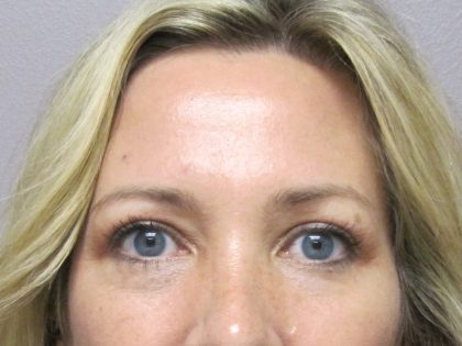 Eyelid Surgery Before & After Patient #1672