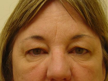 Eyelid Surgery Before & After Patient #1671