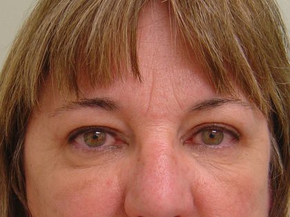 Eyelid Surgery Before & After Patient #1671