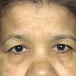 Eyelid Surgery Before & After Patient #1670