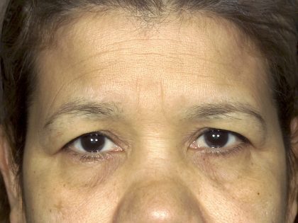 Eyelid Surgery Before & After Patient #1670