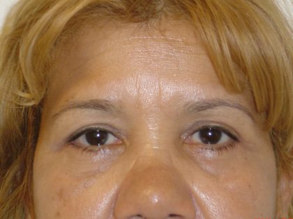 Eyelid Surgery Before & After Patient #1670