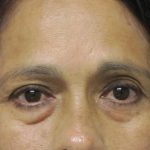 Eyelid Surgery Before & After Patient #1669