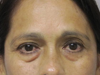 Eyelid Surgery Before & After Patient #1669