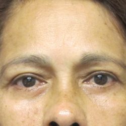 Eyelid Surgery Before & After Patient #1669
