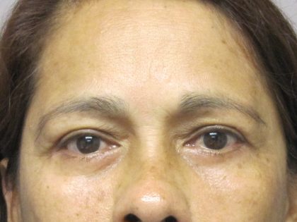 Eyelid Surgery Before & After Patient #1669