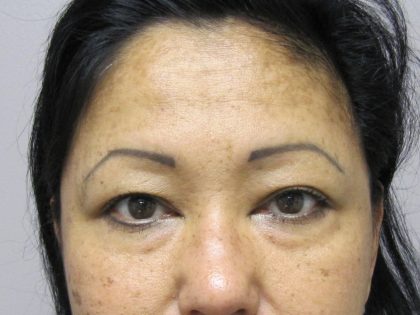 Eyelid Surgery Before & After Patient #1668