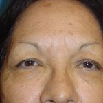 Eyelid Surgery Before & After Patient #1667