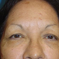 Eyelid Surgery Before & After Patient #1667