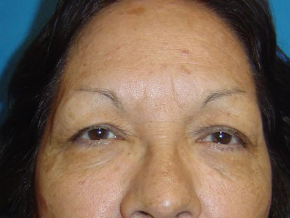 Eyelid Surgery Before & After Patient #1667