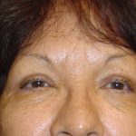 Eyelid Surgery Before & After Patient #1667