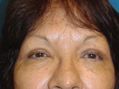 Eyelid Surgery Before & After Patient #1667