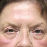 Eyelid Surgery Before & After Patient #1666