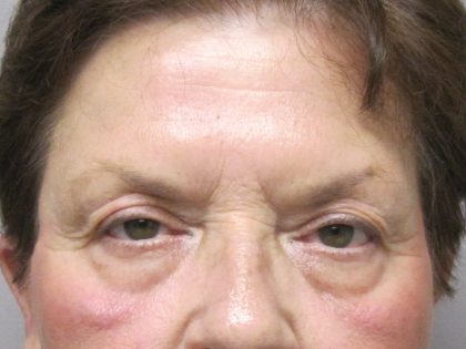 Eyelid Surgery Before & After Patient #1666