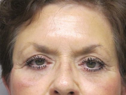 Eyelid Surgery Before & After Patient #1666