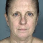 Facelift Before & After Patient #1677