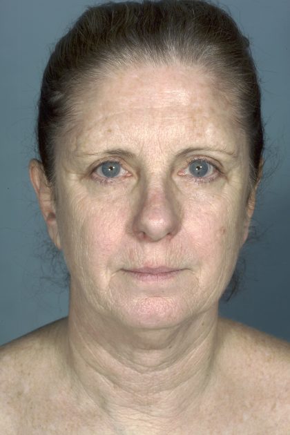 Facelift Before & After Patient #1677