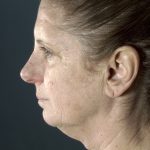 Facelift Before & After Patient #1677