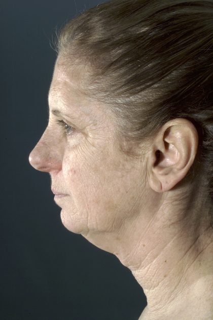 Facelift Before & After Patient #1677