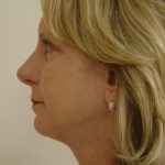 Facelift Before & After Patient #1677