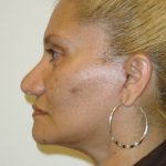 Facelift Before & After Patient #1675