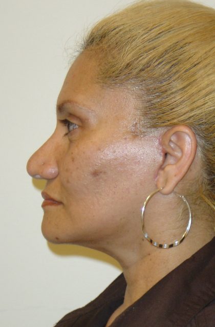 Facelift Before & After Patient #1675